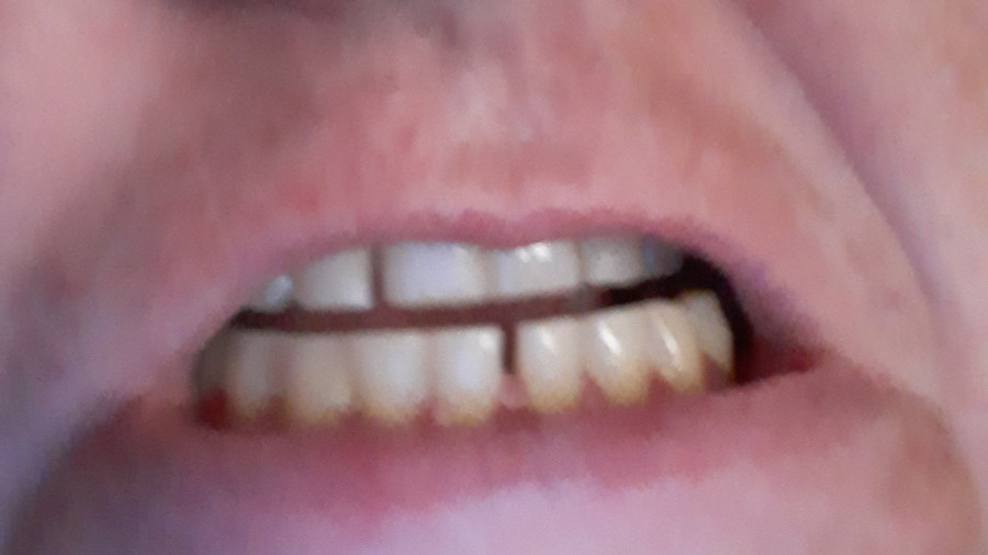 User request 2 tooth gallery