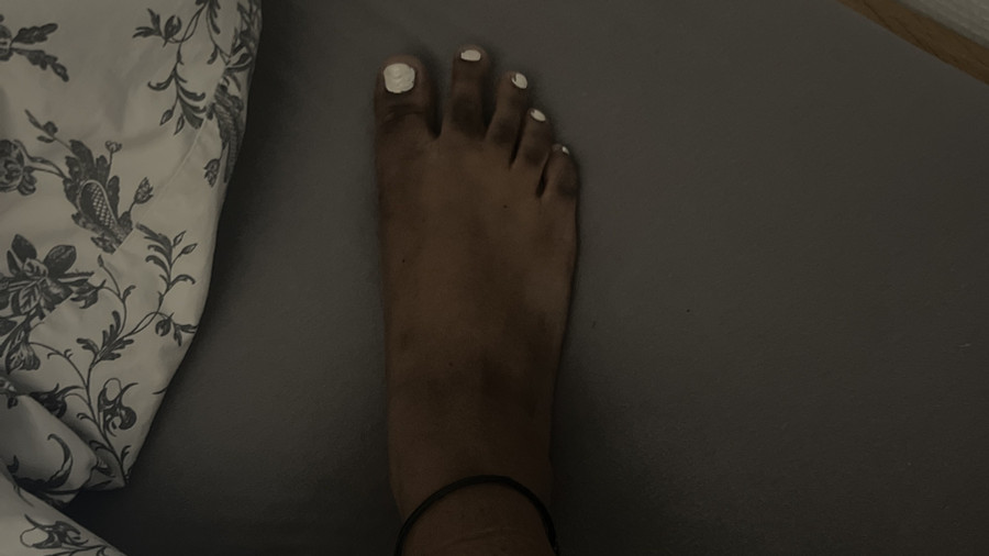 Schwarze Füße mit verkrustetem Nagellack